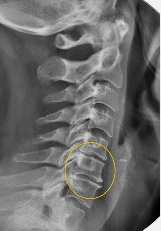 Osteocondrosi della colonna cervicale su un raggio x